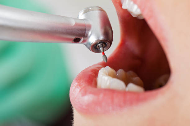 Best Emergency Gum Treatment in Princeton, MN